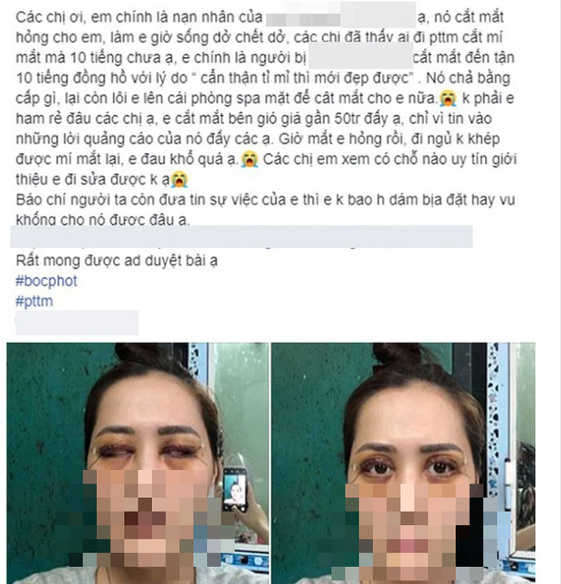 Hậu quả khôn lường từ việc cắt mí mắt tại cơ sở chui giá KHÔNG RẺ: Mắt phải treo ngược cành cây, đi ngủ giờ cũng là thử thách - Ảnh 3. Hậu quả khôn lường từ việc cắt mí mắt tại cơ sở chui giá KHÔNG RẺ: Mắt phải treo ngược cành cây, đi ngủ giờ cũng là thử thách - Ảnh 3.