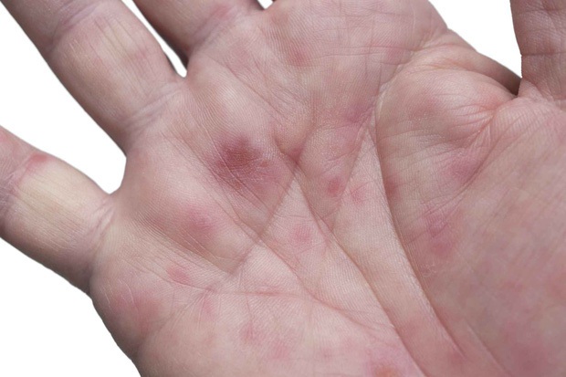 4 thay đổi trên bàn tay cho thấy lá gan của bạn đang cầu cứu, phát hiện sớm có thể điều trị hiệu quả - Ảnh 3.