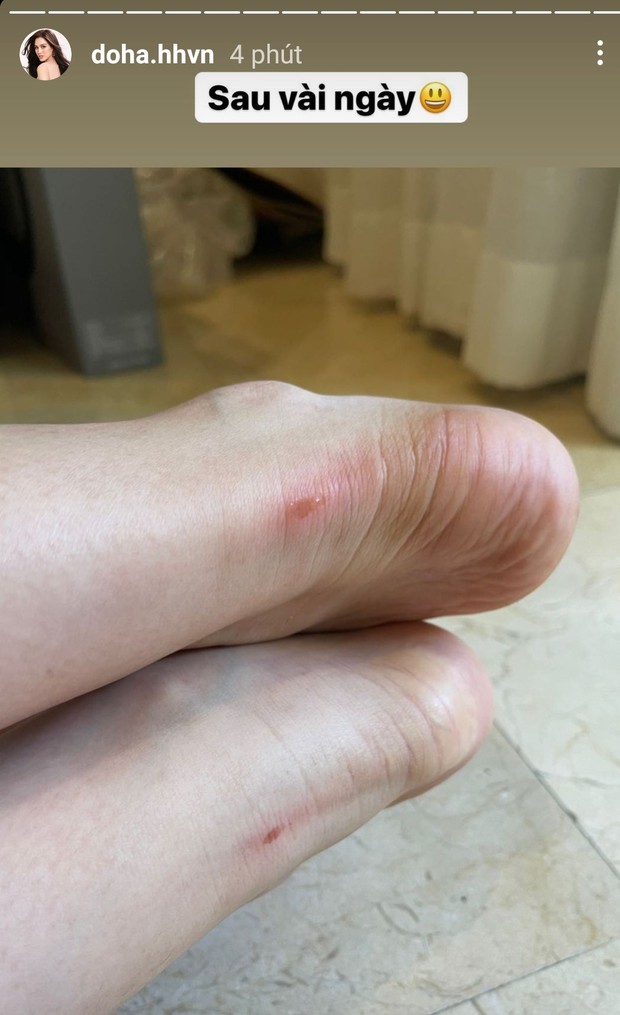 Đỗ Thị Hà trầy da tróc vẩy đi thi Hoa hậu, biết lý do là chị em đồng cảm ngay - Ảnh 1. Đỗ Thị Hà trầy da tróc vẩy đi thi Hoa hậu, biết lý do là chị em đồng cảm ngay - Ảnh 1.