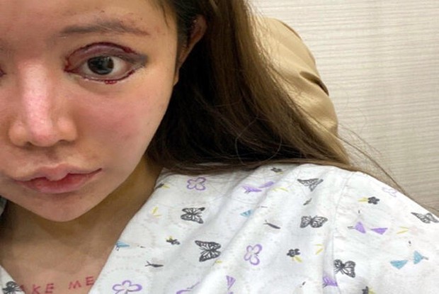 Nữ sinh chi đến 10,6 tỷ phẫu thuật thẩm mỹ, sau 3 năm trở thành người nghiện dao kéo, gương mặt hiện tại khiến ai cũng sốc - Ảnh 3.