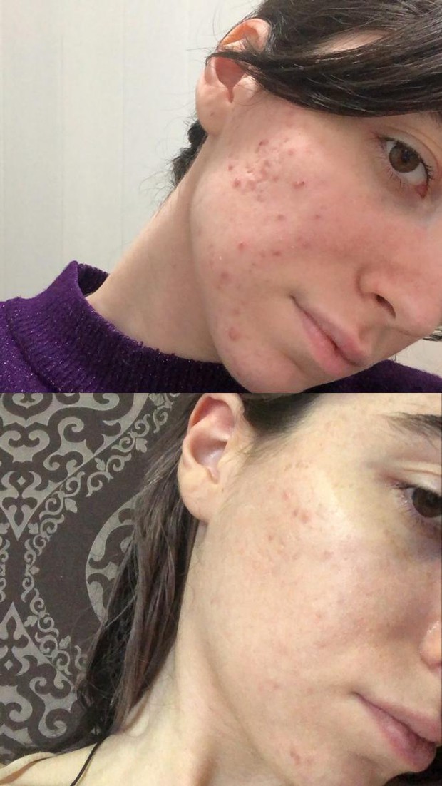 Đây là serum vài năm trước đi đâu bạn cũng thấy, tới giờ vẫn hot khi có gần 600.000 lượt tim trên Sephora, nhưng tranh cãi vẫn còn nhiều lắm - Ảnh 3. Đây là serum vài năm trước đi đâu bạn cũng thấy, tới giờ vẫn hot khi có gần 600.000 lượt tim trên Sephora, nhưng tranh cãi vẫn còn nhiều lắm - Ảnh 3.