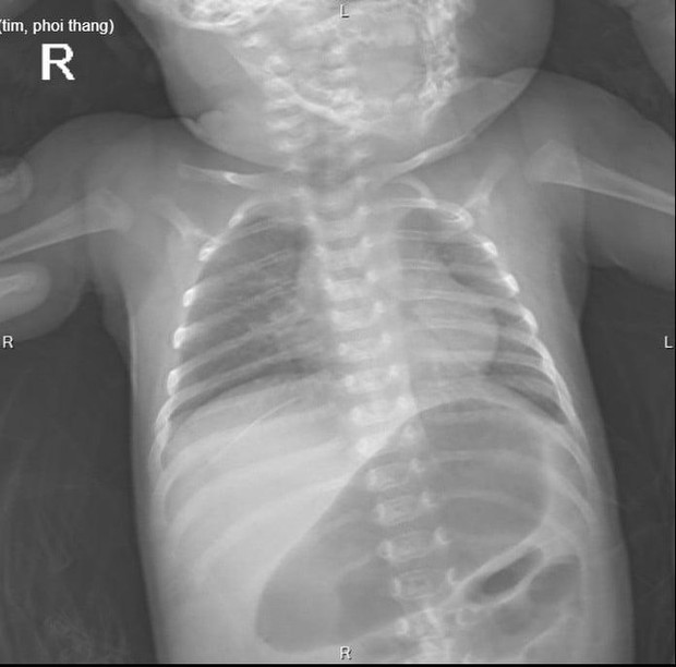 23 ngày sau khi sinh, bé gái mắc bệnh hiểm khiến toàn bộ ruột non nằm trên... phổi - Ảnh 2.