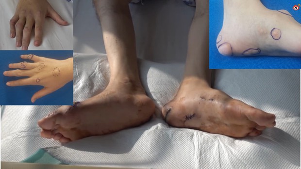 Người đàn ông 30 tuổi bị biến dạng hết các khớp, mụn thịt mọc khắp người chỉ vì 2 thói quen ăn uống phổ biến của người trẻ - Ảnh 2. Người đàn ông 30 tuổi bị biến dạng hết các khớp, mụn thịt mọc khắp người chỉ vì 2 thói quen ăn uống phổ biến của người trẻ - Ảnh 2.