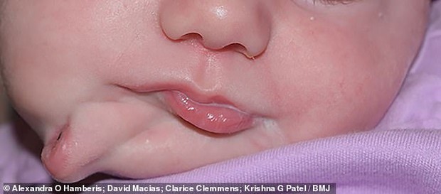 Bé gái sinh ra với chiếc miệng thứ hai ngay dưới cằm, bên trong có cả lưỡi vô cùng hiếm gặp thu hút sự chú ý lớn giờ ra sao? - Ảnh 1. Bé gái sinh ra với chiếc miệng thứ hai ngay dưới cằm, bên trong có cả lưỡi vô cùng hiếm gặp thu hút sự chú ý lớn giờ ra sao? - Ảnh 1.