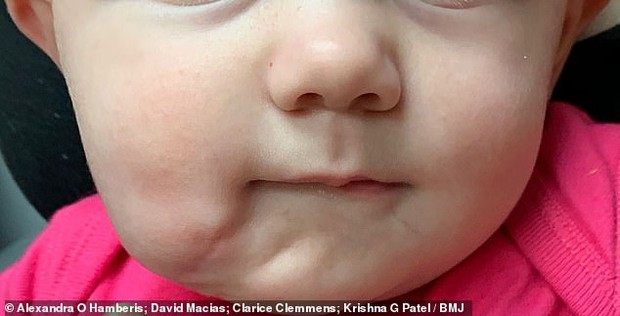 Bé gái sinh ra với chiếc miệng thứ hai ngay dưới cằm, bên trong có cả lưỡi vô cùng hiếm gặp thu hút sự chú ý lớn giờ ra sao? - Ảnh 3. Bé gái sinh ra với chiếc miệng thứ hai ngay dưới cằm, bên trong có cả lưỡi vô cùng hiếm gặp thu hút sự chú ý lớn giờ ra sao? - Ảnh 3.