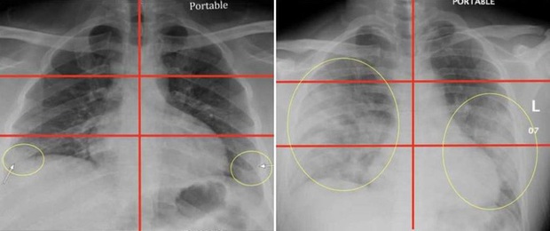 BS so sánh 3 lá phổi: Bệnh nhân Covid-19 có hậu quả tổn thương nghiêm trọng hơn, bị sẹo phổi - Ảnh 2.