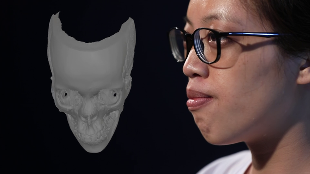 Màn lột xác xuất sắc: Cô gái với chiếc lưỡi khổng lồ bỗng “vịt hoá thiên nga nhờ dao kéo - Ảnh 3.