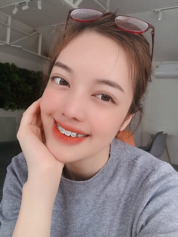 Màn lột xác xuất sắc: Cô gái với chiếc lưỡi khổng lồ bỗng “vịt hoá thiên nga nhờ dao kéo - Ảnh 9.