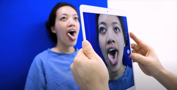 Màn lột xác xuất sắc: Cô gái với chiếc lưỡi khổng lồ bỗng “vịt hoá thiên nga nhờ dao kéo - Ảnh 2.