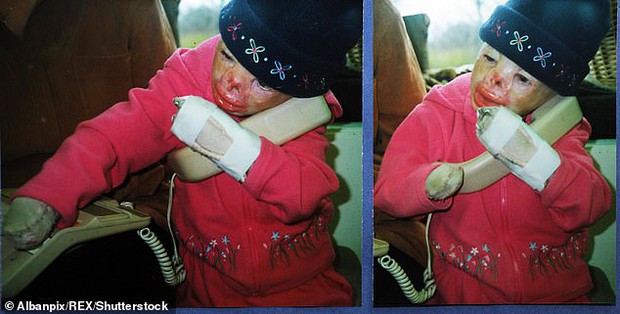 Cô bé từng bỏng nặng đến biến dạng, cứu hoả nhìn cứ ngỡ là búp bê nhựa đen gây bất ngờ với diện mạo và cuộc sống hiện tại - Ảnh 3.