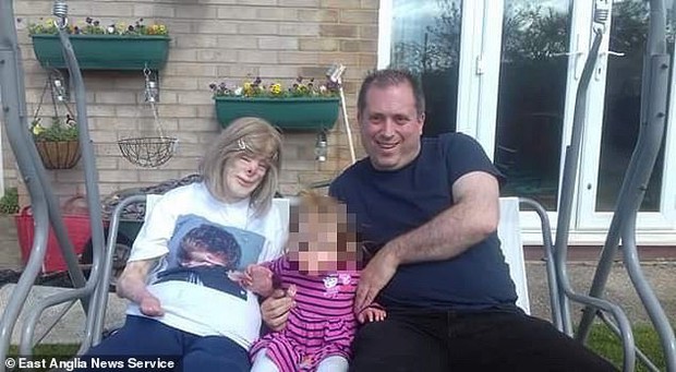 Cô bé từng bỏng nặng đến biến dạng, cứu hoả nhìn cứ ngỡ là búp bê nhựa đen gây bất ngờ với diện mạo và cuộc sống hiện tại - Ảnh 8.