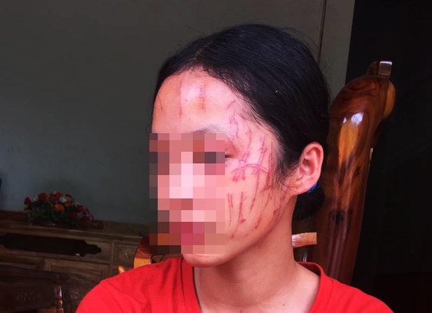 Rùng mình hình ảnh nữ sinh lớp 8 bị đàn chị cào nát mặt: Hé lộ nguyên nhân - Ảnh 1. Rùng mình hình ảnh nữ sinh lớp 8 bị đàn chị cào nát mặt: Hé lộ nguyên nhân - Ảnh 1.