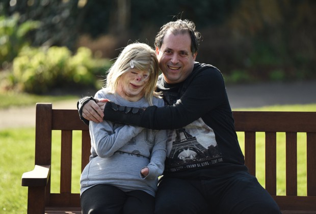 Cô bé từng bỏng nặng đến biến dạng, cứu hoả nhìn cứ ngỡ là búp bê nhựa đen gây bất ngờ với diện mạo và cuộc sống hiện tại - Ảnh 6.