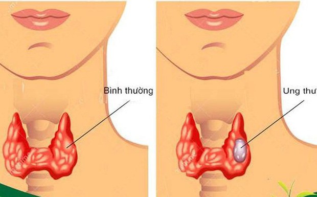 PGĐ Bệnh viện Nội tiết Trung uơng kể chuyện phẫu thuật cho nữ bệnh nhân 15 tuổi mắc u tuyến giáp: Cố chịu đựng, tự nghe ngóng bệnh mới tốn kém - Ảnh 2.