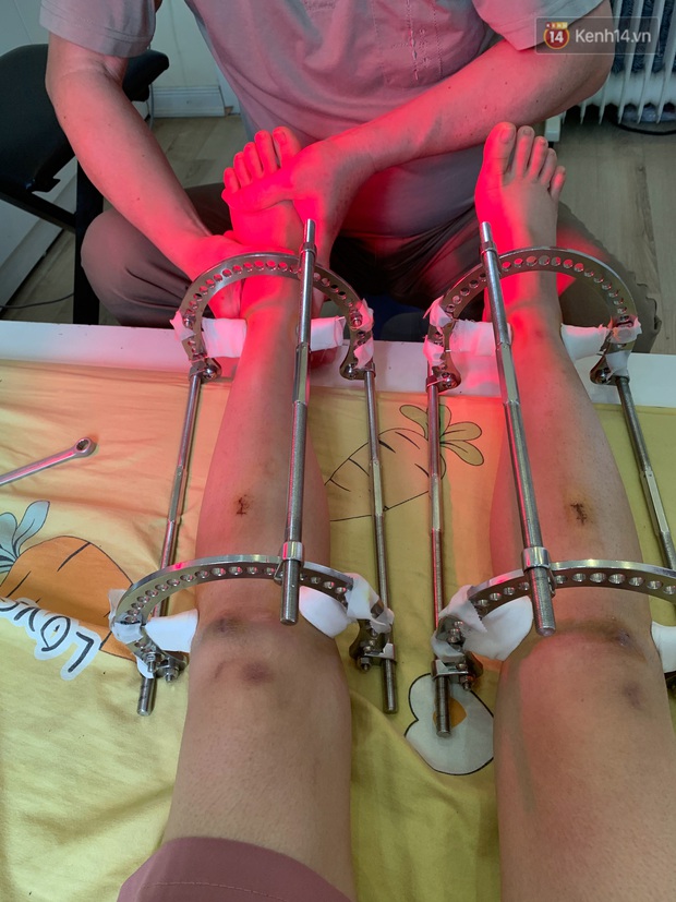 Cô gái Hà Nội giấu bố mẹ đi kéo chân: Không mua quần áo suốt nhiều năm để tiết kiệm, leo lên bàn mổ với ước mơ cao thêm 7cm - Ảnh 5. Cô gái Hà Nội giấu bố mẹ đi kéo chân: Không mua quần áo suốt nhiều năm để tiết kiệm, leo lên bàn mổ với ước mơ cao thêm 7cm - Ảnh 5.