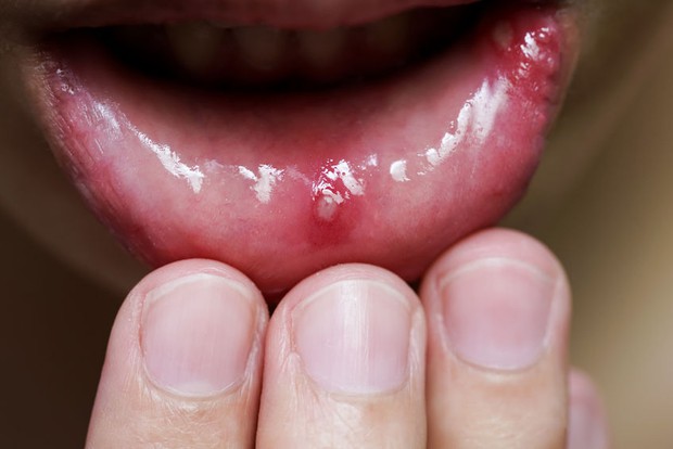 Người gan kém thường có 4 biểu hiện bất thường ở quanh miệng, nếu bạn không có thì xin chúc mừng - Ảnh 3.