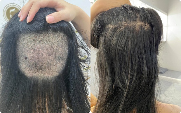 Chi 90 triệu để cấy tóc trị trán dô: Cô nàng này thú nhận từng bất an cực độ vì tóc rụng lả tả, sau nửa năm mới dám thở phào nhẹ nhõm - Ảnh 8.