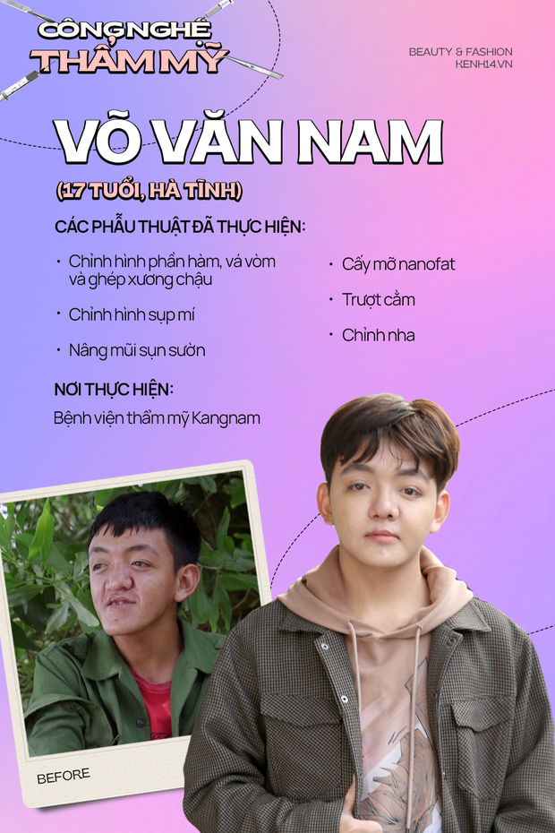 Gen Z Hà Tĩnh có khuôn mặt ông cụ sau phẫu thuật thẩm mỹ: Biến đổi kinh ngạc đến mức khiến bố đẻ bật khóc - Ảnh 2.