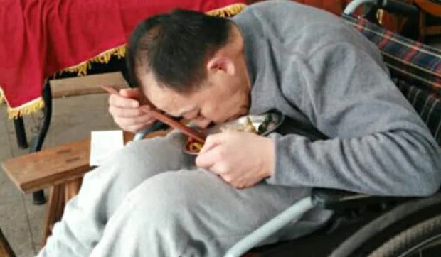 Thanh niên 18 tuổi đột ngột mắc bệnh lạ bị gập đôi người hoàn toàn suốt 3 thập kỷ và cuộc đời “tái sinh” sau phẫu thuật - Ảnh 5.