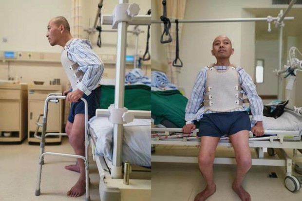 Thanh niên 18 tuổi đột ngột mắc bệnh lạ bị gập đôi người hoàn toàn suốt 3 thập kỷ và cuộc đời “tái sinh” sau phẫu thuật - Ảnh 7.