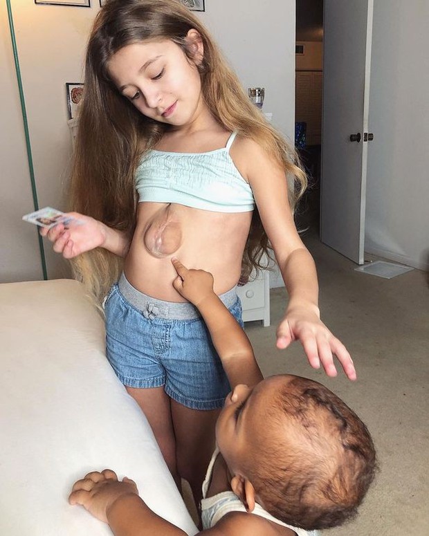 Có trái tim nằm ngoài lồng ngực cực kỳ hiếm gặp, bé gái vừa ra đời đã được gọi là phép màu y học giờ thế nào? - Ảnh 7. Có trái tim nằm ngoài lồng ngực cực kỳ hiếm gặp, bé gái vừa ra đời đã được gọi là phép màu y học giờ thế nào? - Ảnh 7.