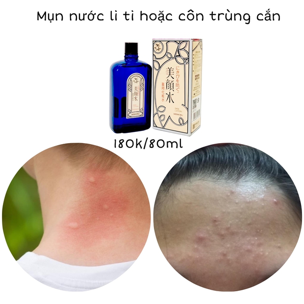 Da có mụn thành căng bóng mỹ mãn: Cô nàng này chỉ toàn mua đồ chấm mụn quen thuộc, giá cả bình dân chỉ từ 120k - Ảnh 15. Da có mụn thành căng bóng mỹ mãn: Cô nàng này chỉ toàn mua đồ chấm mụn quen thuộc, giá cả bình dân chỉ từ 120k - Ảnh 15.