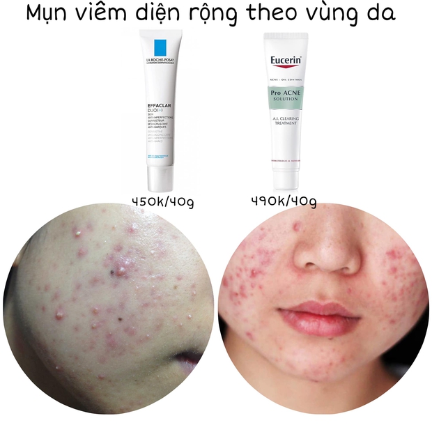 Da có mụn thành căng bóng mỹ mãn: Cô nàng này chỉ toàn mua đồ chấm mụn quen thuộc, giá cả bình dân chỉ từ 120k - Ảnh 12. Da có mụn thành căng bóng mỹ mãn: Cô nàng này chỉ toàn mua đồ chấm mụn quen thuộc, giá cả bình dân chỉ từ 120k - Ảnh 12.