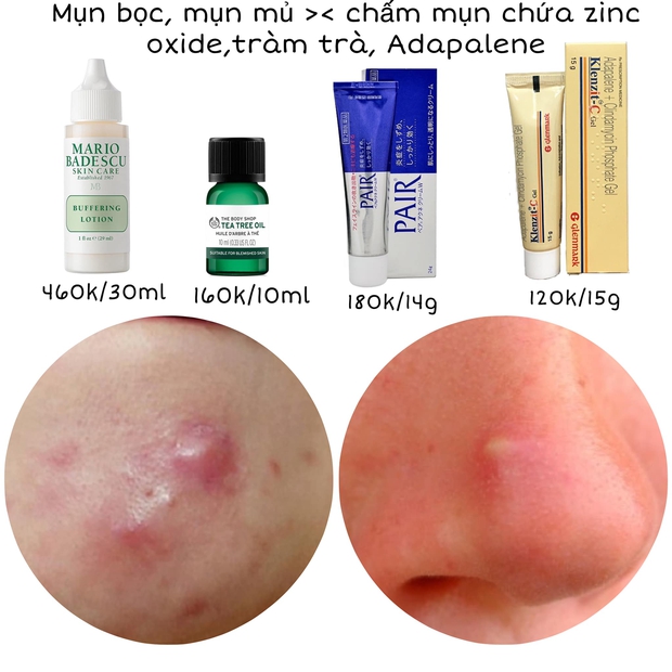 Da có mụn thành căng bóng mỹ mãn: Cô nàng này chỉ toàn mua đồ chấm mụn quen thuộc, giá cả bình dân chỉ từ 120k - Ảnh 7. Da có mụn thành căng bóng mỹ mãn: Cô nàng này chỉ toàn mua đồ chấm mụn quen thuộc, giá cả bình dân chỉ từ 120k - Ảnh 7.