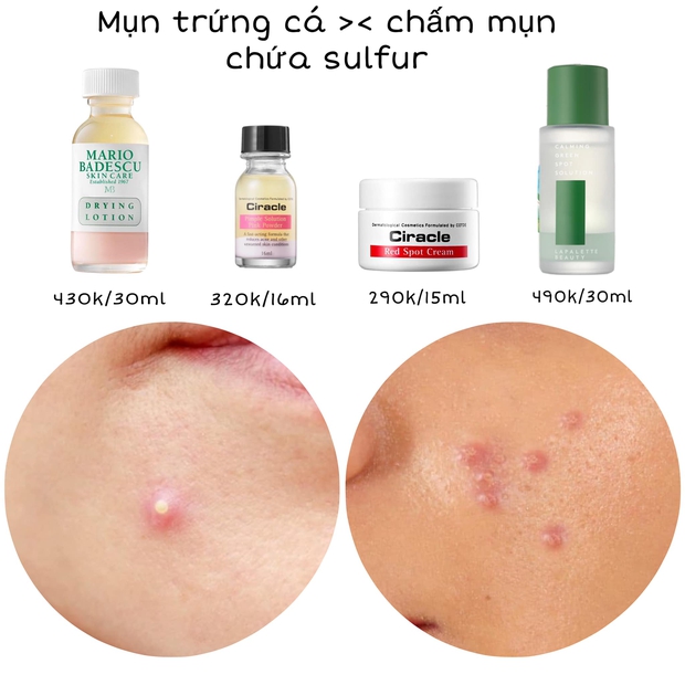 Da có mụn thành căng bóng mỹ mãn: Cô nàng này chỉ toàn mua đồ chấm mụn quen thuộc, giá cả bình dân chỉ từ 120k - Ảnh 2. Da có mụn thành căng bóng mỹ mãn: Cô nàng này chỉ toàn mua đồ chấm mụn quen thuộc, giá cả bình dân chỉ từ 120k - Ảnh 2.