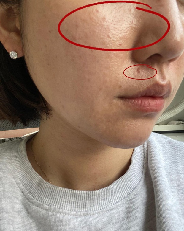 Cải thiện lỗ chân lông to: 5 điều nhất định phải làm để da dẻ láng mịn không còn vết tích - Ảnh 2. Cải thiện lỗ chân lông to: 5 điều nhất định phải làm để da dẻ láng mịn không còn vết tích - Ảnh 2.