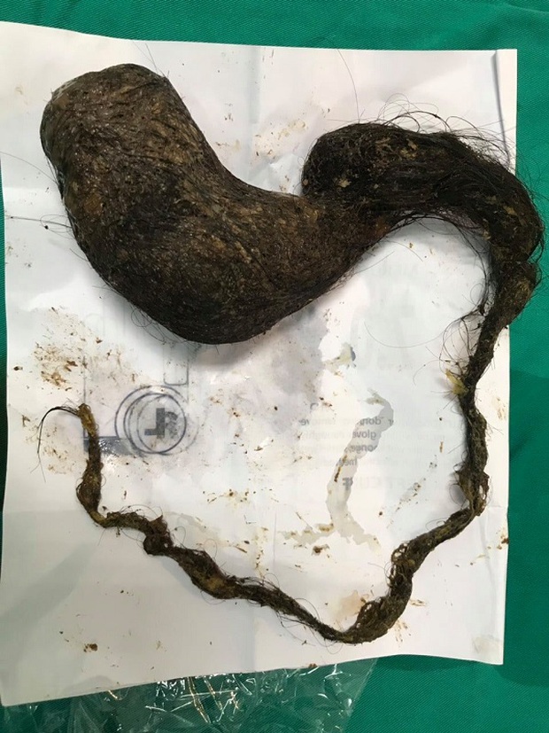 Chỉ vì 1 thói quen xấu, bé gái 11 tuổi có khối tóc nặng gần 1kg trong bụng - Ảnh 1.