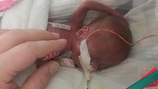 Bé trai sinh non tới hơn 4 tháng, sớm nhất thế giới với tỉ lệ sống sót là 0% và kết cục khiến cả thế giới phải trầm trồ - Ảnh 1.