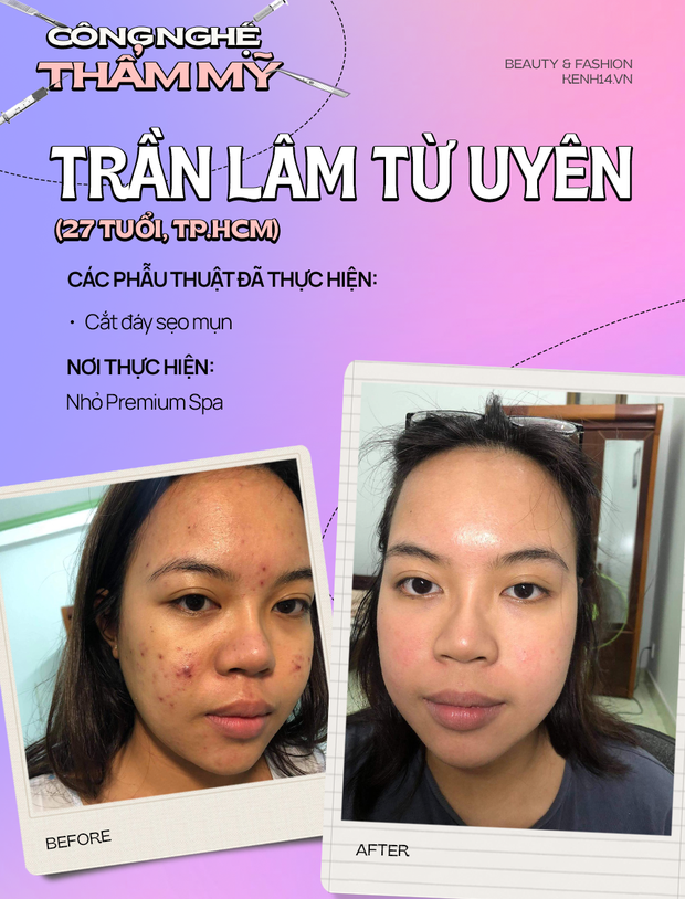 Review chi tiết quá trình cắt sẹo mụn: Đúng là rất đau, cơ mà đáng lắm! - Ảnh 1. Review chi tiết quá trình cắt sẹo mụn: Đúng là rất đau, cơ mà đáng lắm! - Ảnh 1.