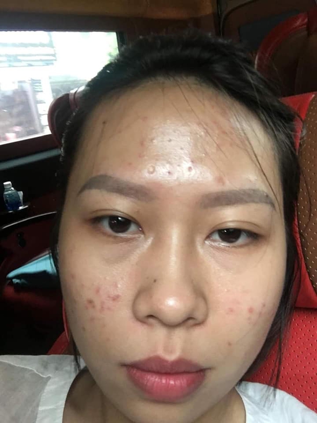 Da vừa khô vừa mụn vì không chăm sóc kĩ mỗi khi đi du lịch, cô nàng tốn 7 tháng để lấy lại làn da mịn màng với quy trình skincare 5 bước - Ảnh 2. Da vừa khô vừa mụn vì không chăm sóc kĩ mỗi khi đi du lịch, cô nàng tốn 7 tháng để lấy lại làn da mịn màng với quy trình skincare 5 bước - Ảnh 2.