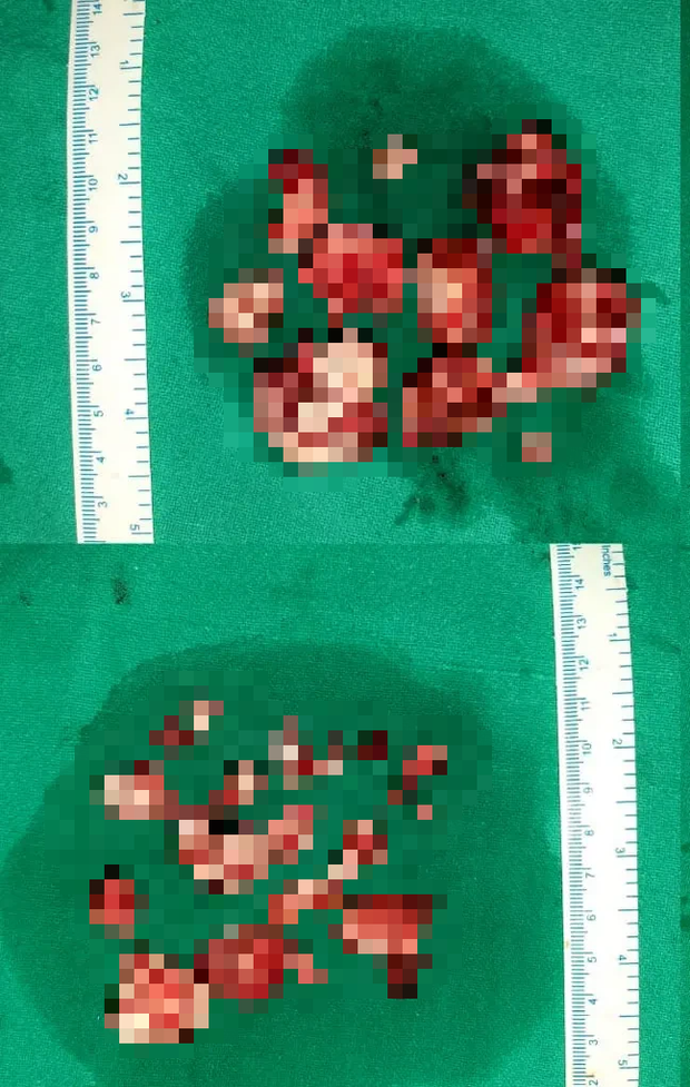 Đi khám bác sĩ vì mặt biến dạng, chàng trai bị nhổ một phát 82 chiếc răng nằm trong khối u to đùng dưới hàm - Ảnh 4. Đi khám bác sĩ vì mặt biến dạng, chàng trai bị nhổ một phát 82 chiếc răng nằm trong khối u to đùng dưới hàm - Ảnh 4.