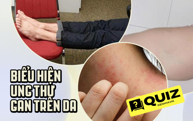 Quiz: Nếu có 4 biểu hiện bất thường sau trên da thì 80% đó là biểu hiện cho thấy ung thư gan đã bắt đầu ghé thăm - Ảnh 1. Quiz: Nếu có 4 biểu hiện bất thường sau trên da thì 80% đó là biểu hiện cho thấy ung thư gan đã bắt đầu ghé thăm - Ảnh 1.