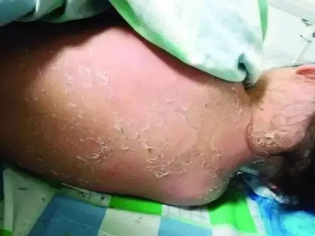 Bé gái 8 tuổi bị nổi nốt đỏ ở khóe miệng, rụng cả mảng da lớn sau khi tắm tại bể bơi công cộng - Ảnh 1.