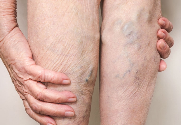 5 triệu chứng ở chân cho thấy cơ thể bạn đang trên đà lão hóa, mắc phải dù chỉ 1 cái cũng đã rất đáng lo - Ảnh 5.
