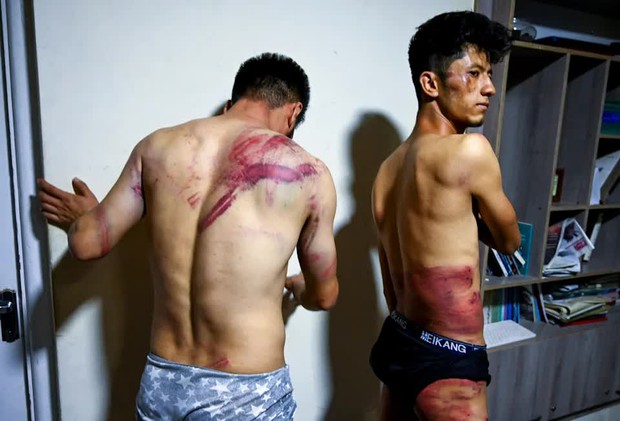 Hai phóng viên Afghanistan toàn thân đầy vết thương kinh hoàng do Taliban tra tấn vì đi lấy tin: Tôi cứ nghĩ chúng sẽ giết tôi - Ảnh 1. Hai phóng viên Afghanistan toàn thân đầy vết thương kinh hoàng do Taliban tra tấn vì đi lấy tin: Tôi cứ nghĩ chúng sẽ giết tôi - Ảnh 1.