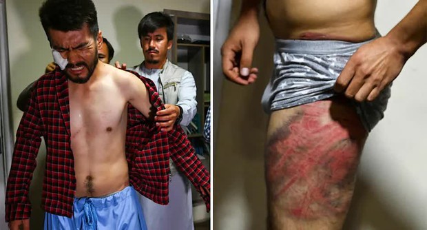 Hai phóng viên Afghanistan toàn thân đầy vết thương kinh hoàng do Taliban tra tấn vì đi lấy tin: Tôi cứ nghĩ chúng sẽ giết tôi - Ảnh 2. Hai phóng viên Afghanistan toàn thân đầy vết thương kinh hoàng do Taliban tra tấn vì đi lấy tin: Tôi cứ nghĩ chúng sẽ giết tôi - Ảnh 2.