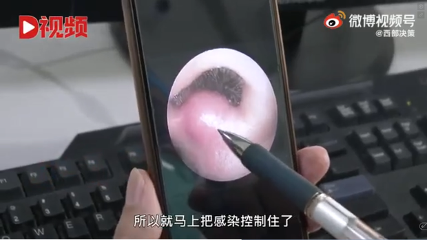 Cậu bé 8 tuổi suýt chết vì nhiễm trùng não, nguyên nhân bởi thói quen chẳng ai ngờ: Ngoáy mũi - Ảnh 2. Cậu bé 8 tuổi suýt chết vì nhiễm trùng não, nguyên nhân bởi thói quen chẳng ai ngờ: Ngoáy mũi - Ảnh 2.
