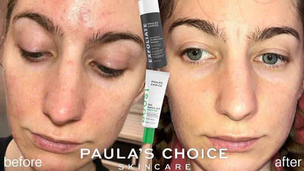 Hơn 14 nghìn người trên Sephora thả tim cho tuýp kem trị thâm mụn, sưng đỏ này, không thử là phí bạn ơi! - Ảnh 5. Hơn 14 nghìn người trên Sephora thả tim cho tuýp kem trị thâm mụn, sưng đỏ này, không thử là phí bạn ơi! - Ảnh 5.