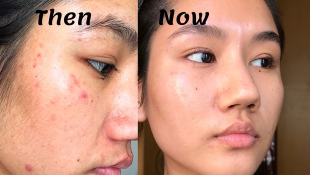 Hơn 14 nghìn người trên Sephora thả tim cho tuýp kem trị thâm mụn, sưng đỏ này, không thử là phí bạn ơi! - Ảnh 4. Hơn 14 nghìn người trên Sephora thả tim cho tuýp kem trị thâm mụn, sưng đỏ này, không thử là phí bạn ơi! - Ảnh 4.