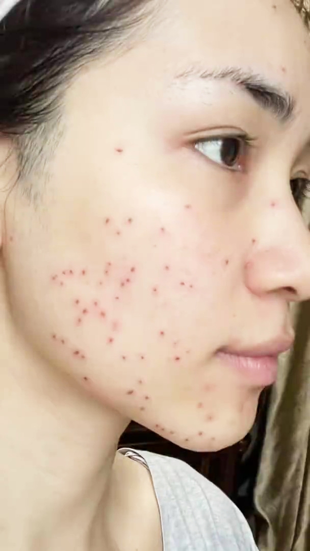 Hòa Minzy có 1 vấn đề nhức nhối trên da và đây là cách cô khắc phục nó - Ảnh 6. Hòa Minzy có 1 vấn đề nhức nhối trên da và đây là cách cô khắc phục nó - Ảnh 6.