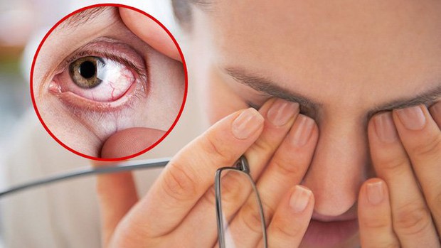 3 biểu hiện bất thường ở mắt ngầm cảnh báo gan có vấn đề, xem thử bạn có dấu hiệu nào hay không - Ảnh 1.