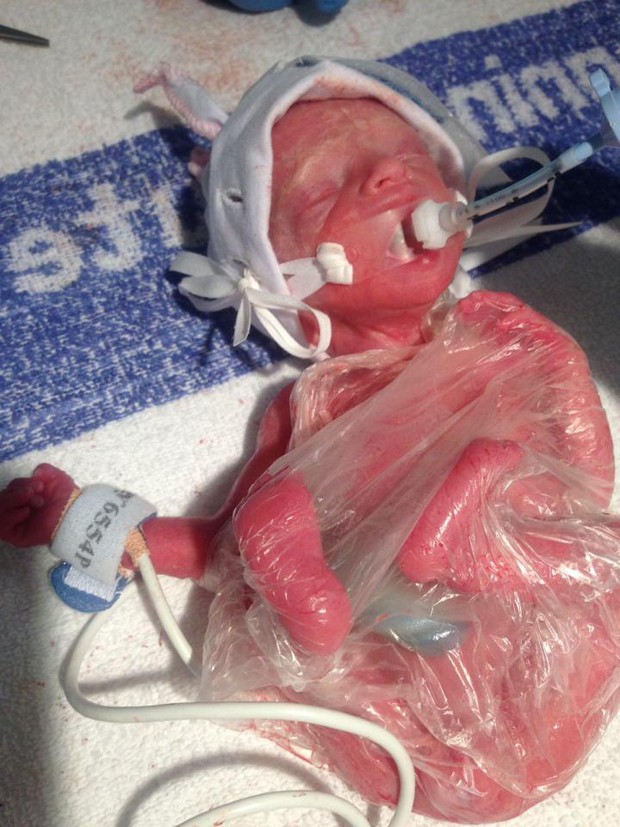 Bé gái nặng vỏn vẹn 6 lạng nằm gọn trong túi nylon chiến đấu với Tử thần nổi tiếng khắp thế giới 5 năm trước giờ ra sao? - Ảnh 2.