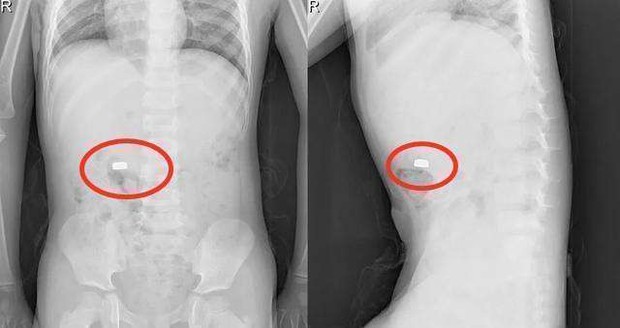 Con trai rỉ tai nói: Con sẽ kể cho mẹ một bí mật! - Nghe xong người mẹ hoảng hốt đưa con đến bệnh viện ngay - Ảnh 2. Con trai rỉ tai nói: Con sẽ kể cho mẹ một bí mật! - Nghe xong người mẹ hoảng hốt đưa con đến bệnh viện ngay - Ảnh 2.