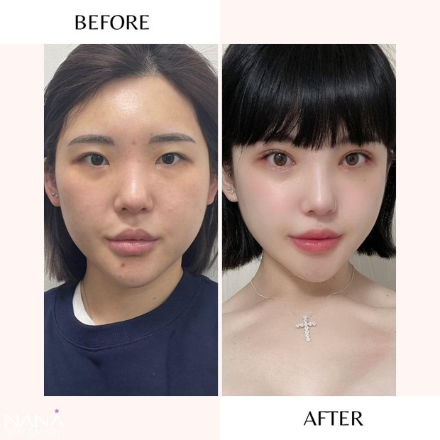 Bác sĩ thẩm mỹ tiết lộ 3 thủ thuật bị từ chối: Vừa giả tạo, vừa dễ gây nhiễm trùng cực nặng! - Ảnh 4. Bác sĩ thẩm mỹ tiết lộ 3 thủ thuật bị từ chối: Vừa giả tạo, vừa dễ gây nhiễm trùng cực nặng! - Ảnh 4.