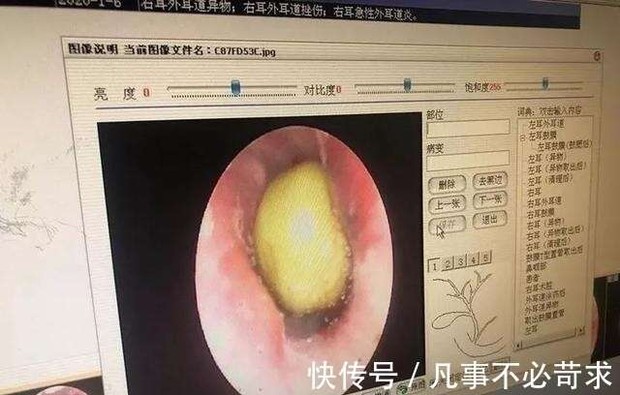 Con trai 8 tuổi khóc thảm thiết, bố mẹ đưa đến bác sĩ thì phát hiện con nhét một thứ vào tai, khi lấy ra ai xem cũng hãi - Ảnh 2. Con trai 8 tuổi khóc thảm thiết, bố mẹ đưa đến bác sĩ thì phát hiện con nhét một thứ vào tai, khi lấy ra ai xem cũng hãi - Ảnh 2.