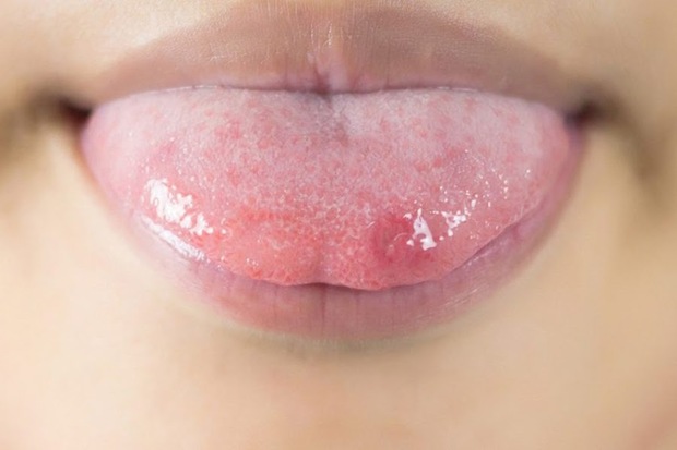 Lưỡi cũng có thể bị ung thư, nhưng khi xuất hiện những dấu hiệu bất thường nhiều người lại lầm tưởng là nhiệt miệng  - Ảnh 1.